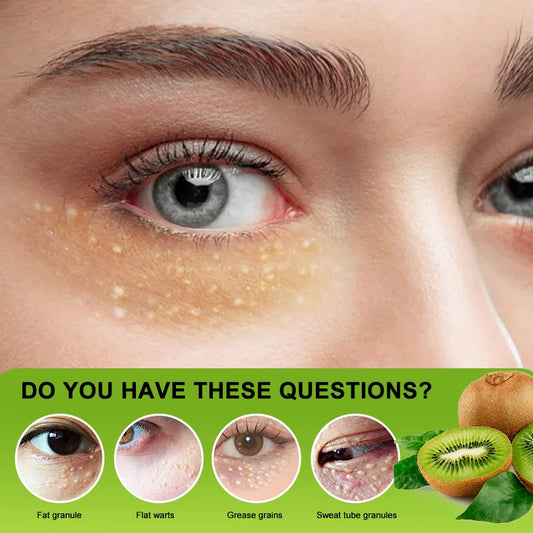 Milia & Puffiness Eye Cream – For Dark Circles, Eye Bags & Tired-Looking Eyes