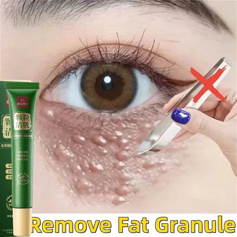 Fat Granules Remover Eye Cream Anti-Puffiness Anti Inflammatory Reduce Dark Circles Eyebags Fade Lines Moisturizing Eye Care