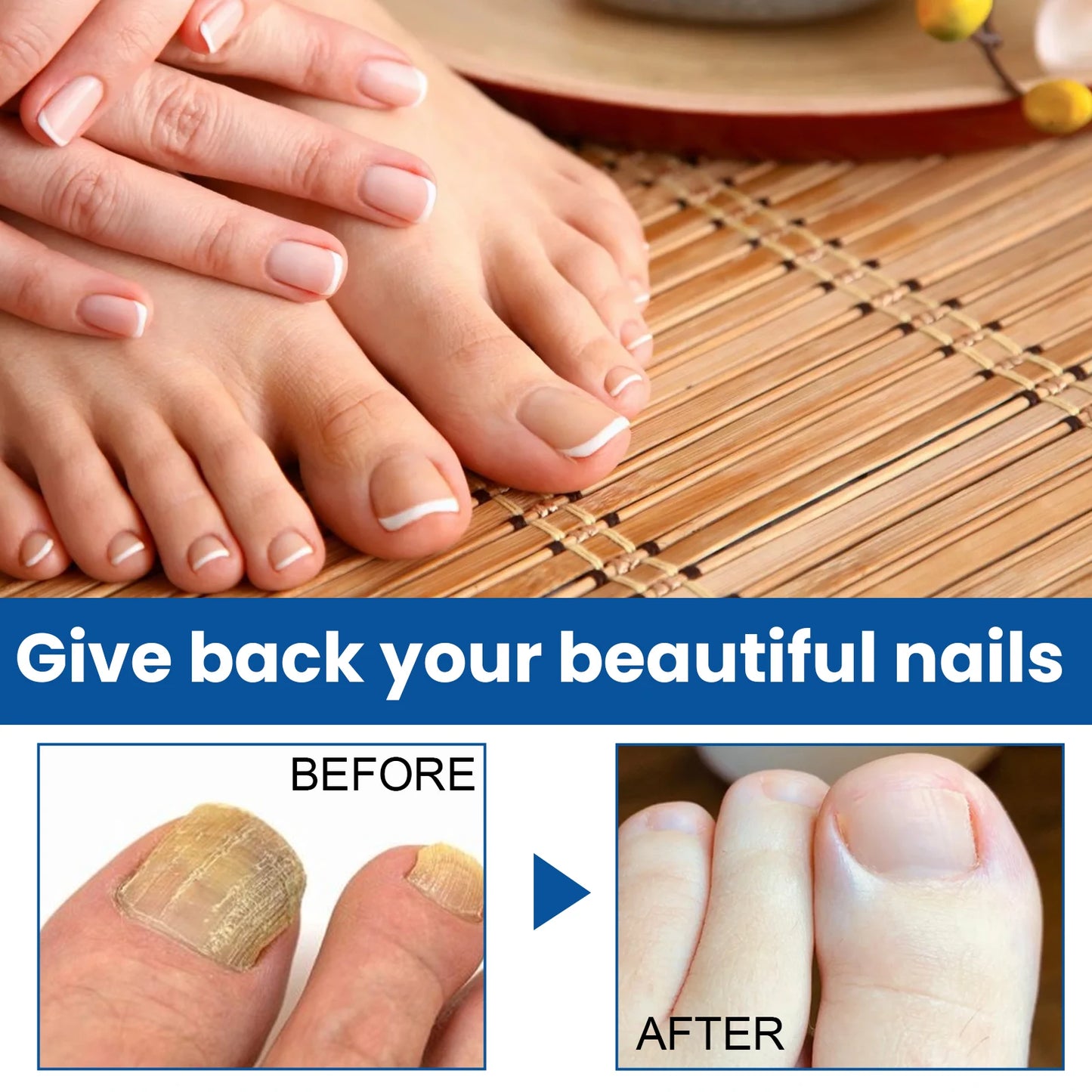 West&Month Nail Fungus Repair Liquid Hand Foot Skin Care Serum Remove Infected Thicken Bright Fungal Treat Soft Hand Foot Care