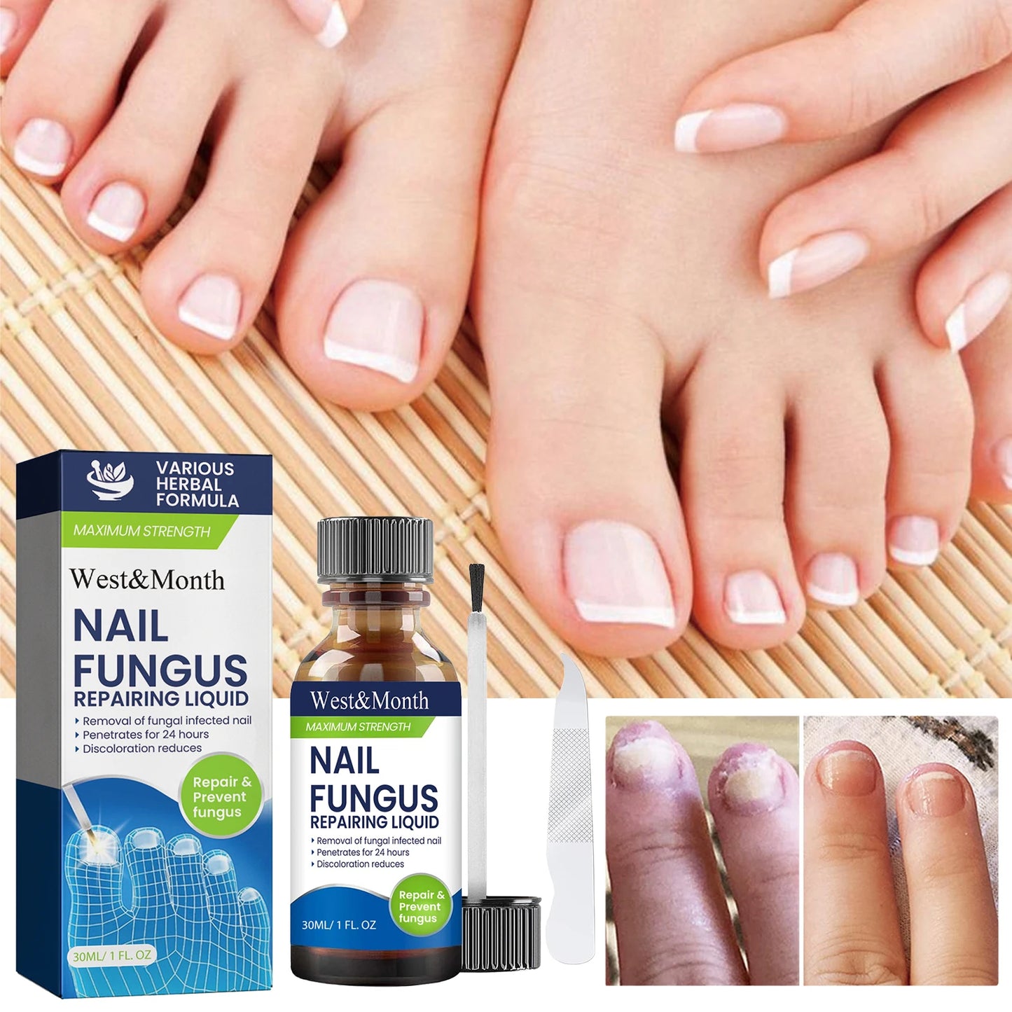 West&Month Nail Fungus Repair Liquid Hand Foot Skin Care Serum Remove Infected Thicken Bright Fungal Treat Soft Hand Foot Care