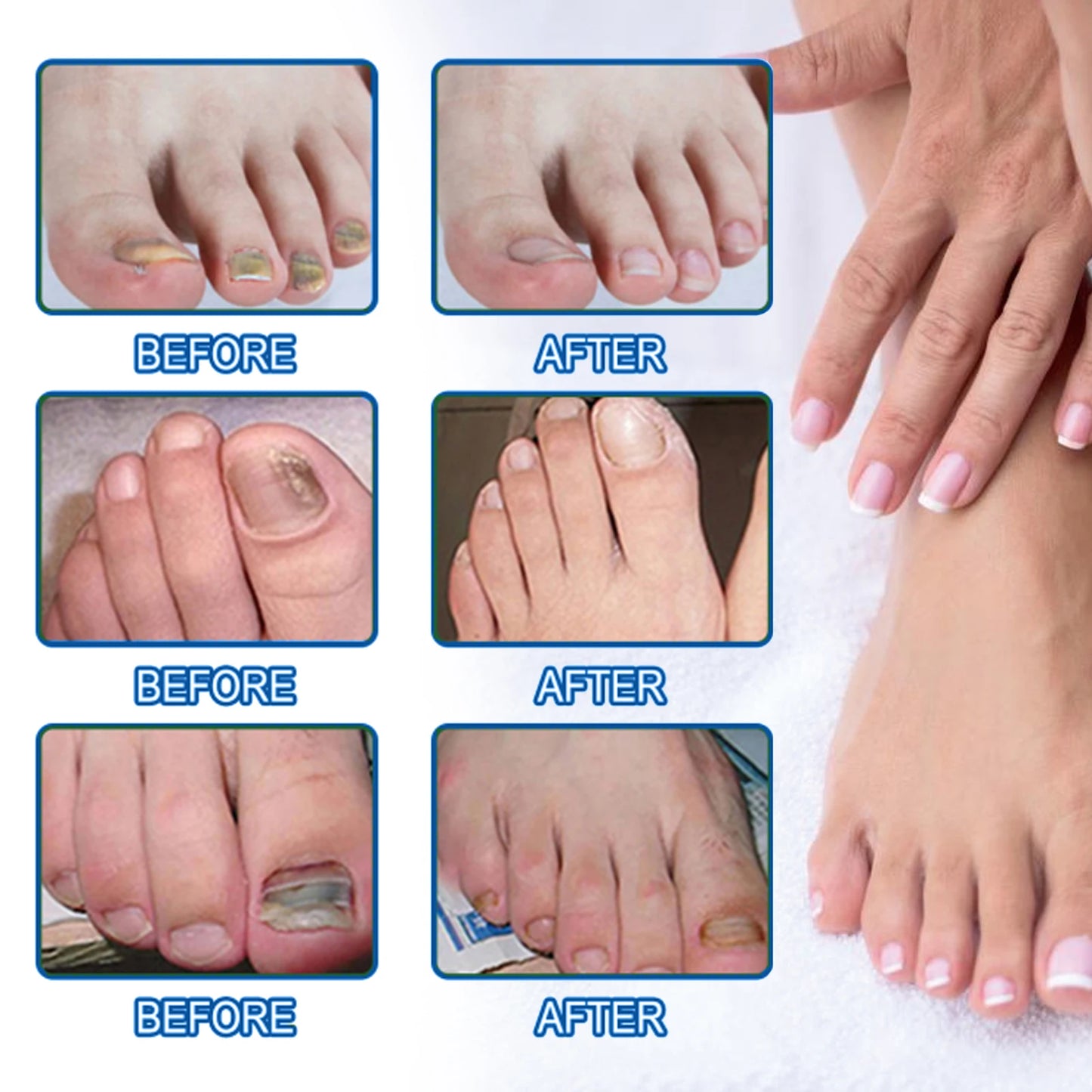 West&Month Nail Fungus Repair Liquid Hand Foot Skin Care Serum Remove Infected Thicken Bright Fungal Treat Soft Hand Foot Care