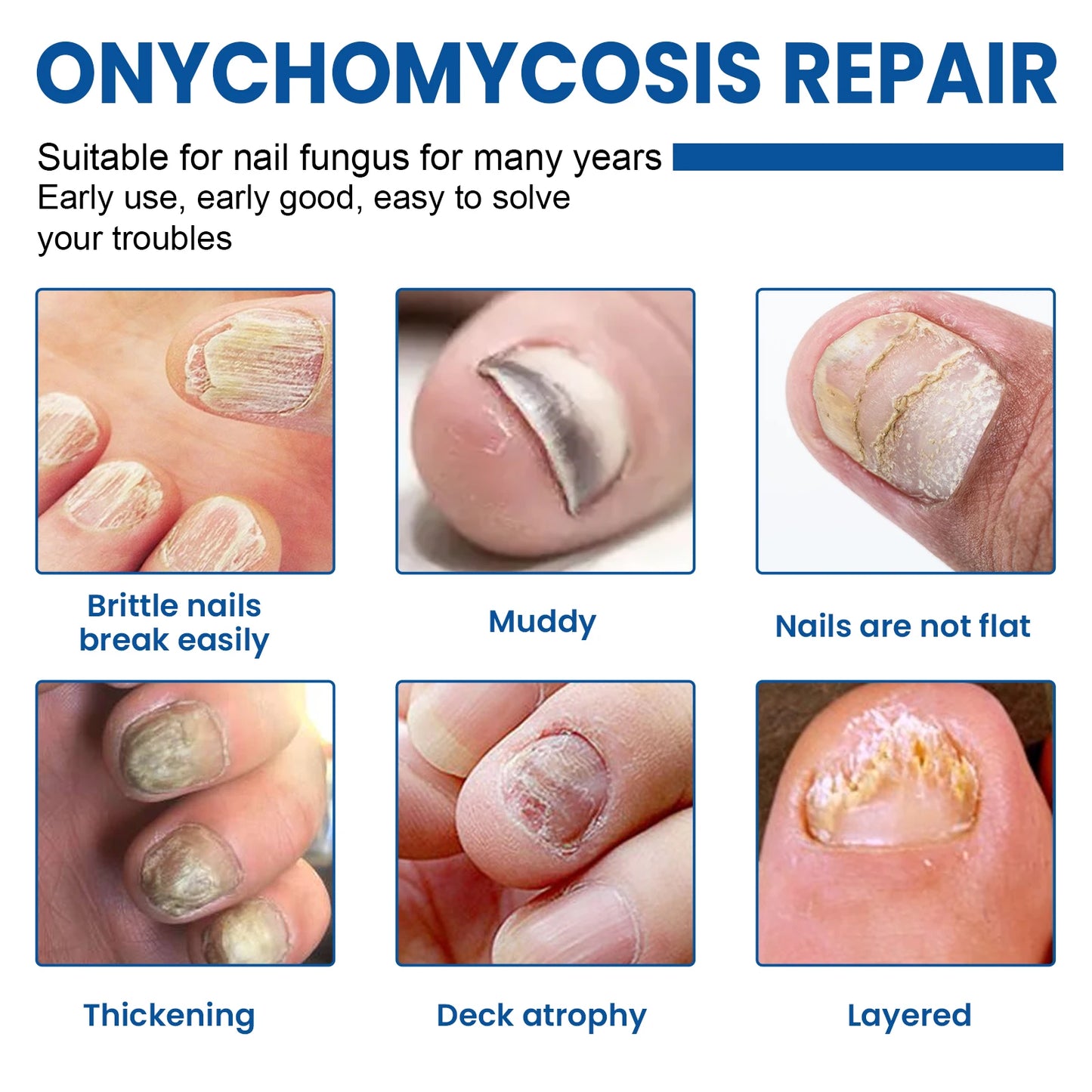 West&Month Nail Fungus Repair Liquid Hand Foot Skin Care Serum Remove Infected Thicken Bright Fungal Treat Soft Hand Foot Care