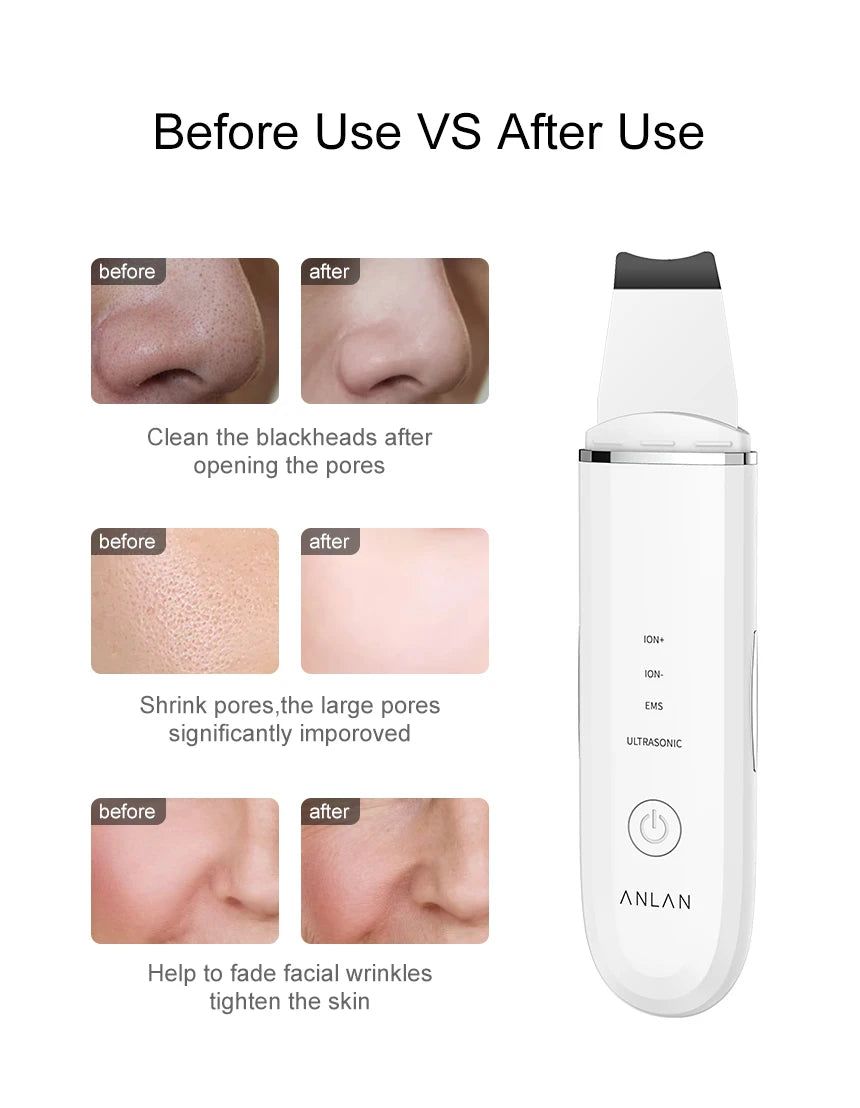 ANLAN Ultrasonic Skin Scrubber Facial Pore Cleansing Spatula Microcurrent Facial Lifting Ultrasonic Peeling Beauty Skincare Tool