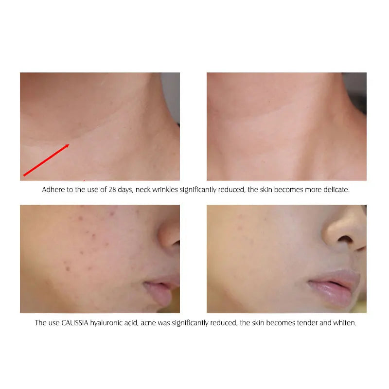 ARTISCARE Hyaluron Acid Serum 10pcs/Lot for Face Moisturizing and Hydrating Skin Care Essence Facial Care