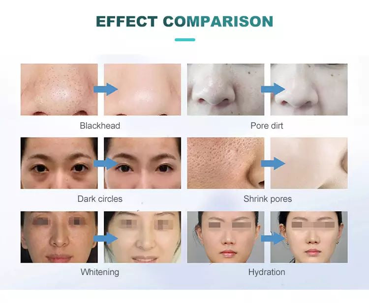 7-in-1 Hydro Facial Skin Care Machine Ultrasonic Rejuvenation Dermabrasion Hyperbaric Oxygen Facial Device for Deep Cleansing