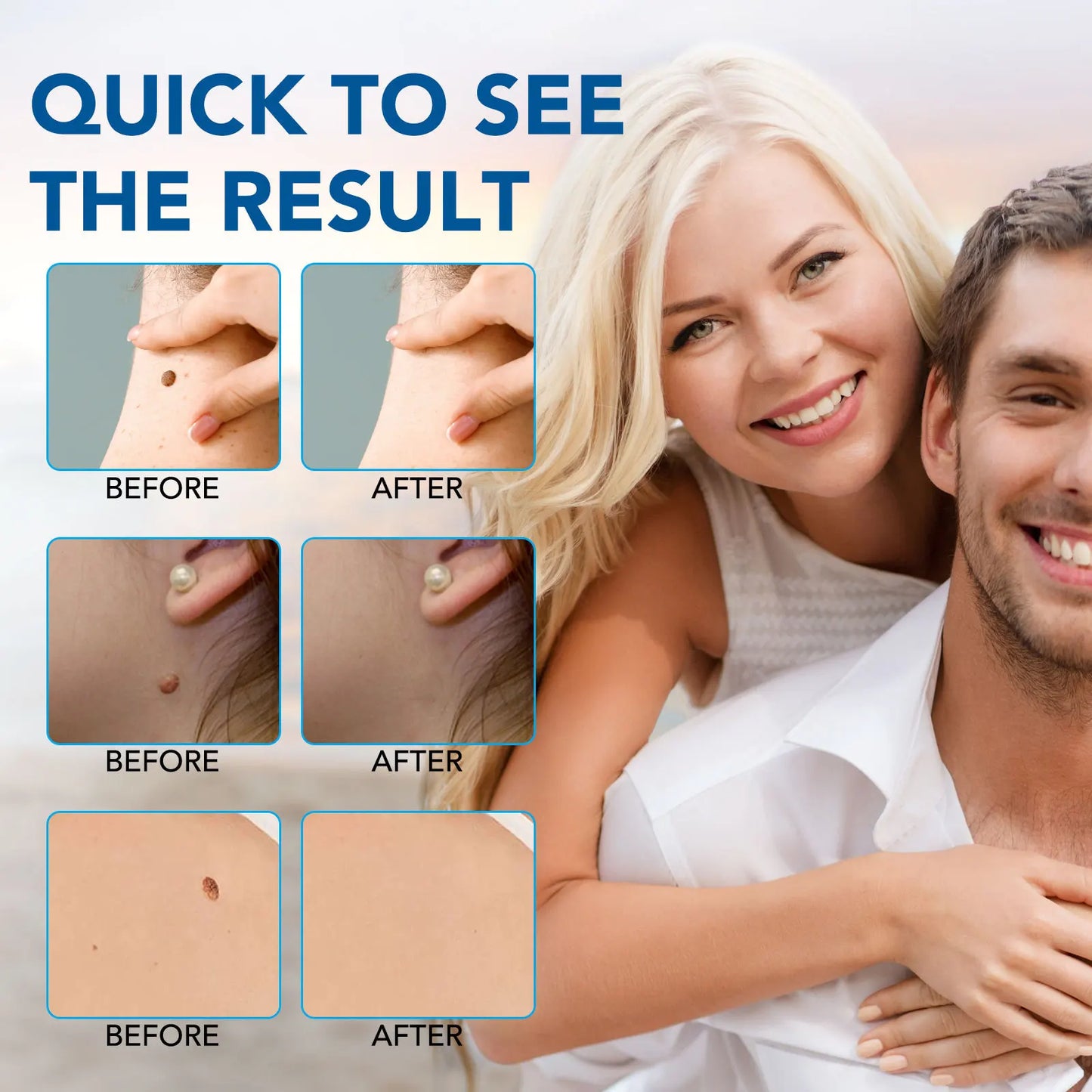 2 IN 1 Auto Micro Skin Tag Remover Device Standard And Micro Skin Tag Removal Kit Adult Mole Wart Remover Face Care Beauty Tools