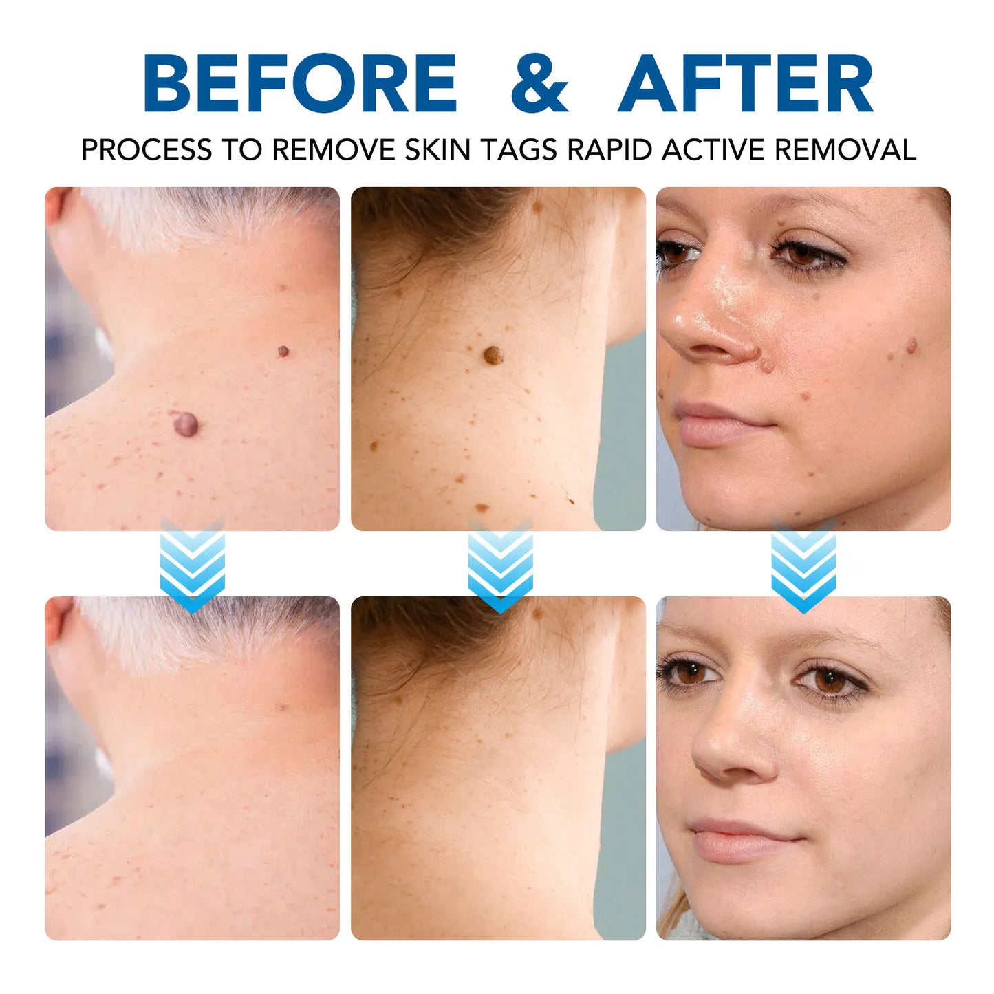 2 IN 1 Auto Micro Skin Tag Remover Device Standard And Micro Skin Tag Removal Kit Adult Mole Wart Remover Face Care Beauty Tools