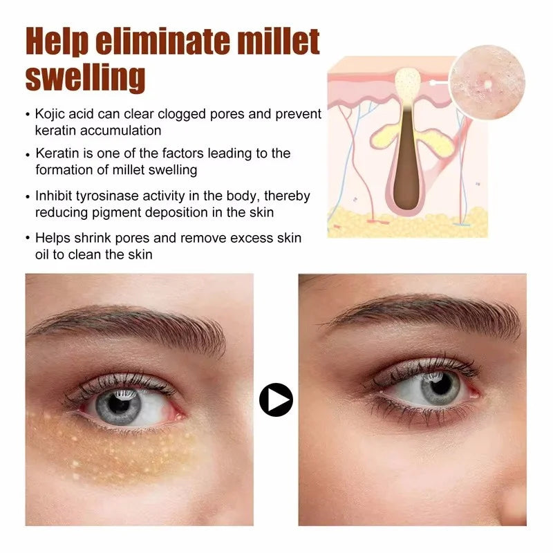Fat Granules Remover Eye Cream Anti-Puffiness Anti Inflammatory Reduce Dark Circles Eyebags Fade Lines Moisturizing Eye Care