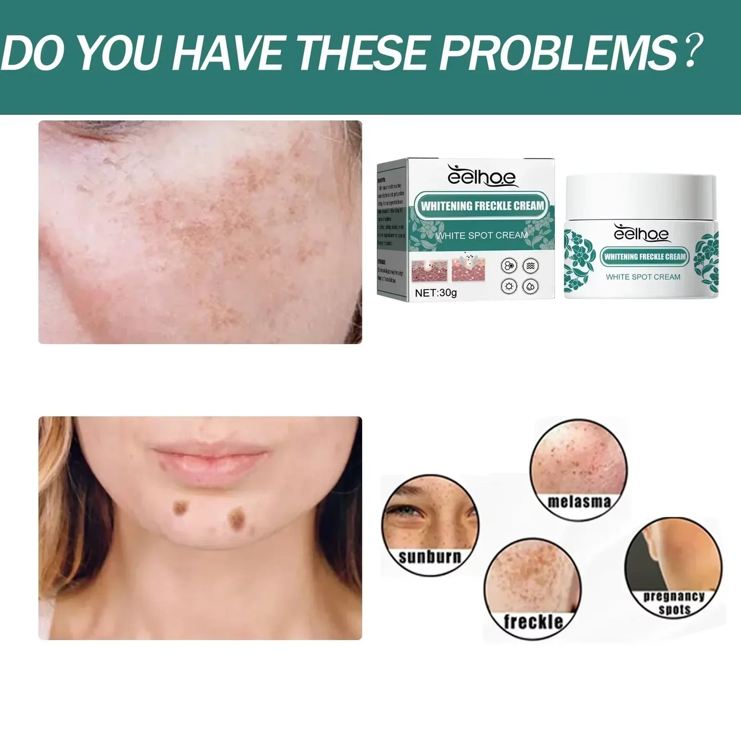 eelhoe Niacinamide Melasma Brightening Cream Reduce Melanin Brighten Cream Lighten Dark Skin Chloasma Serum Fade Fine Face Lines