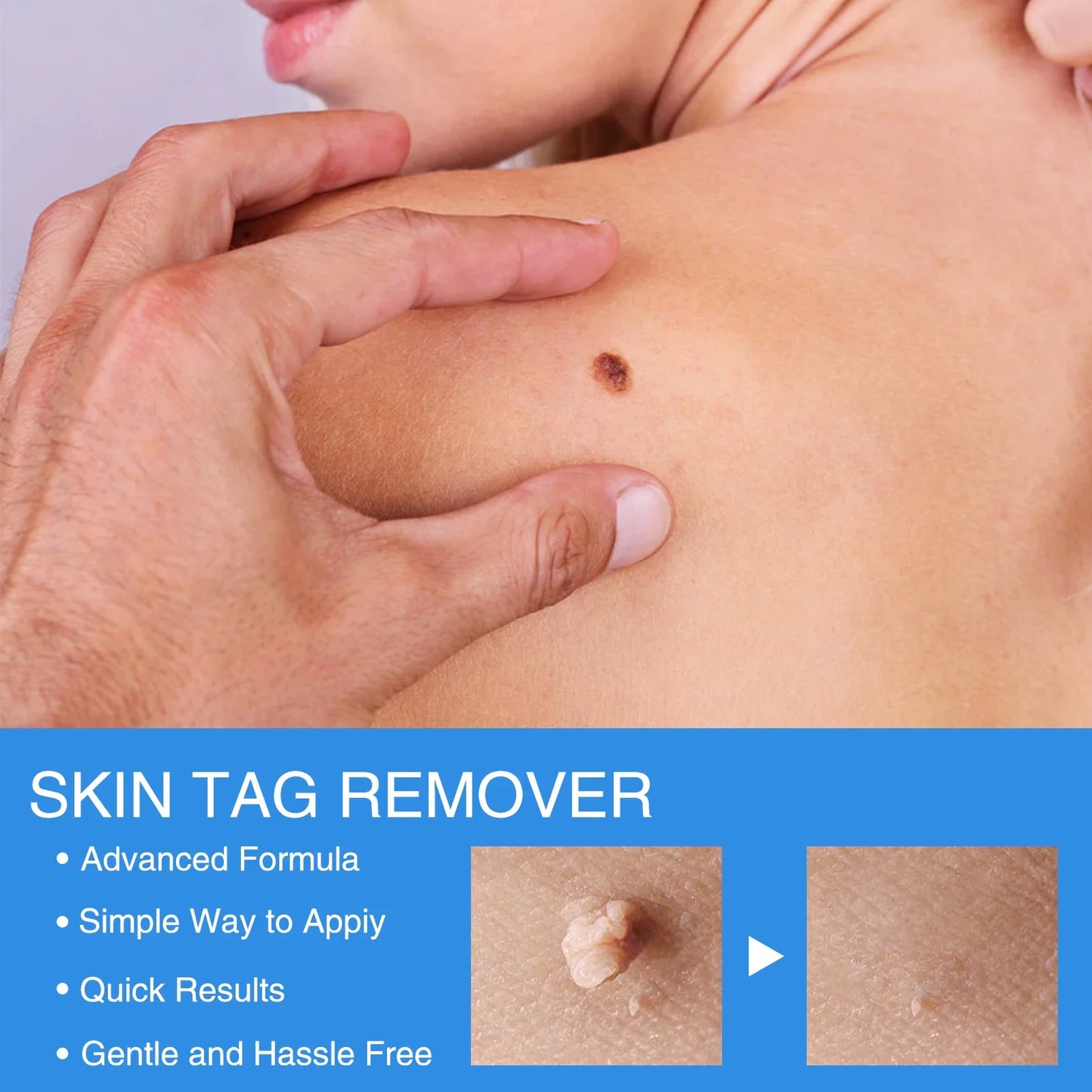 2 IN 1 Auto Micro Skin Tag Remover Device Standard And Micro Skin Tag Removal Kit Adult Mole Wart Remover Face Care Beauty Tools
