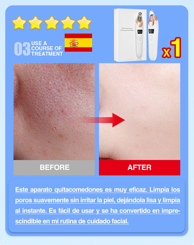 Electric Blackhead Remover Vacuum – Pore Cleaner & Acne Extractor | Facial Deep Cleaning Tool