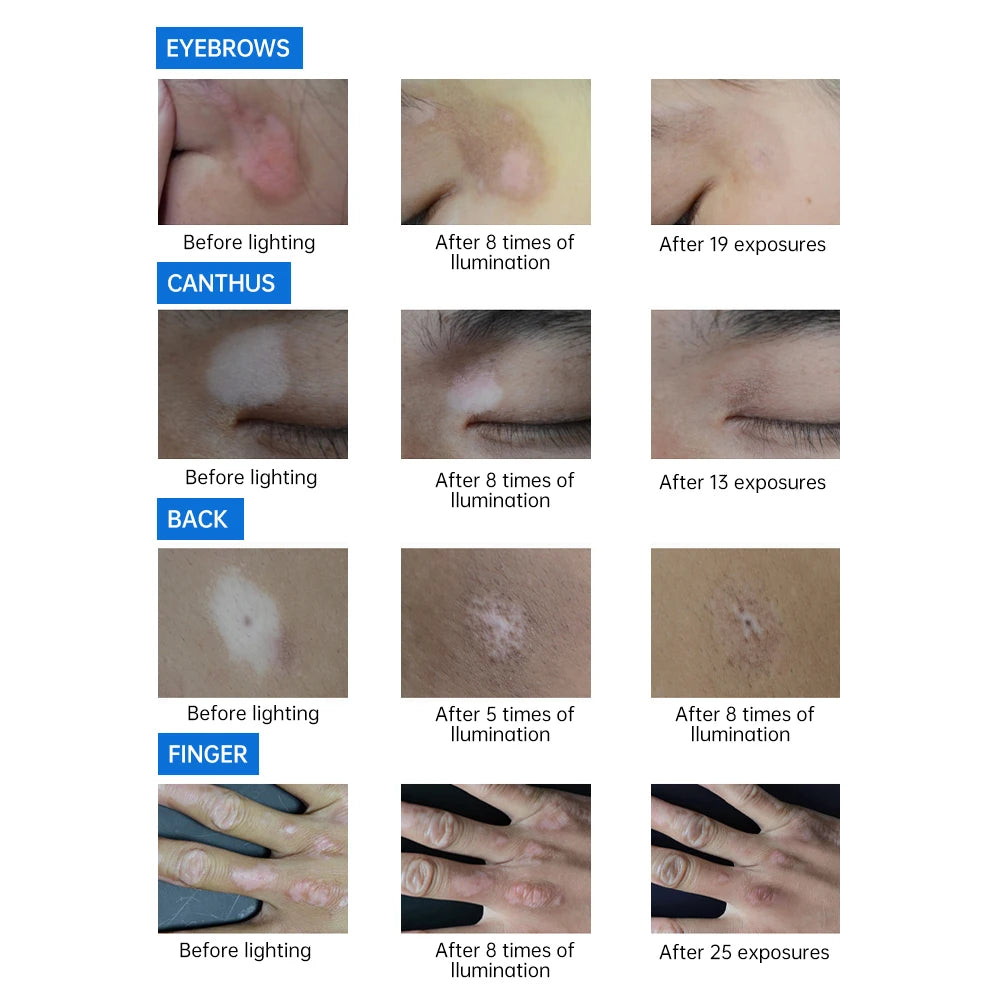 YOUWEMED 311nm Ultraviolet Phototherapy Instrument Use UVB Lamp UV for Vitiligo Psoriasis White Spots Skin Disease