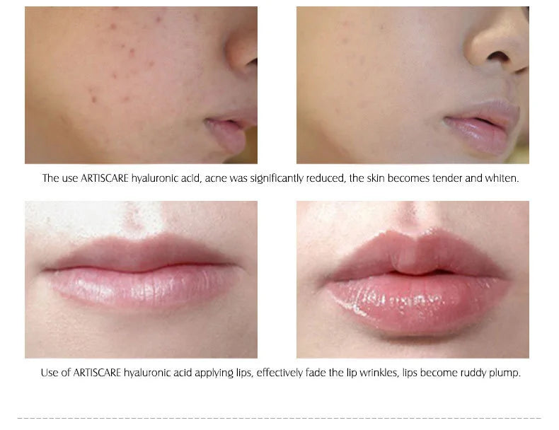 ARTISCARE Hyaluron Acid Serum 10pcs/Lot for Face Moisturizing and Hydrating Skin Care Essence Facial Care