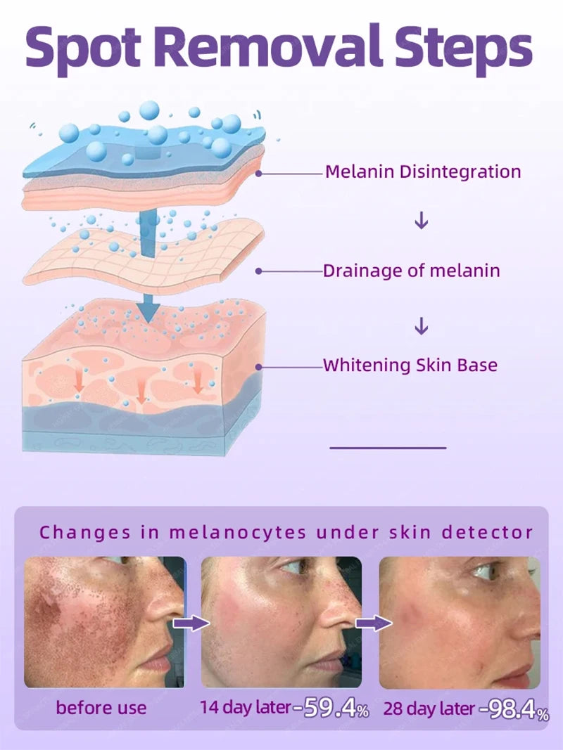 Facial Lightening for Freckles, Melasma & Dark Spots
