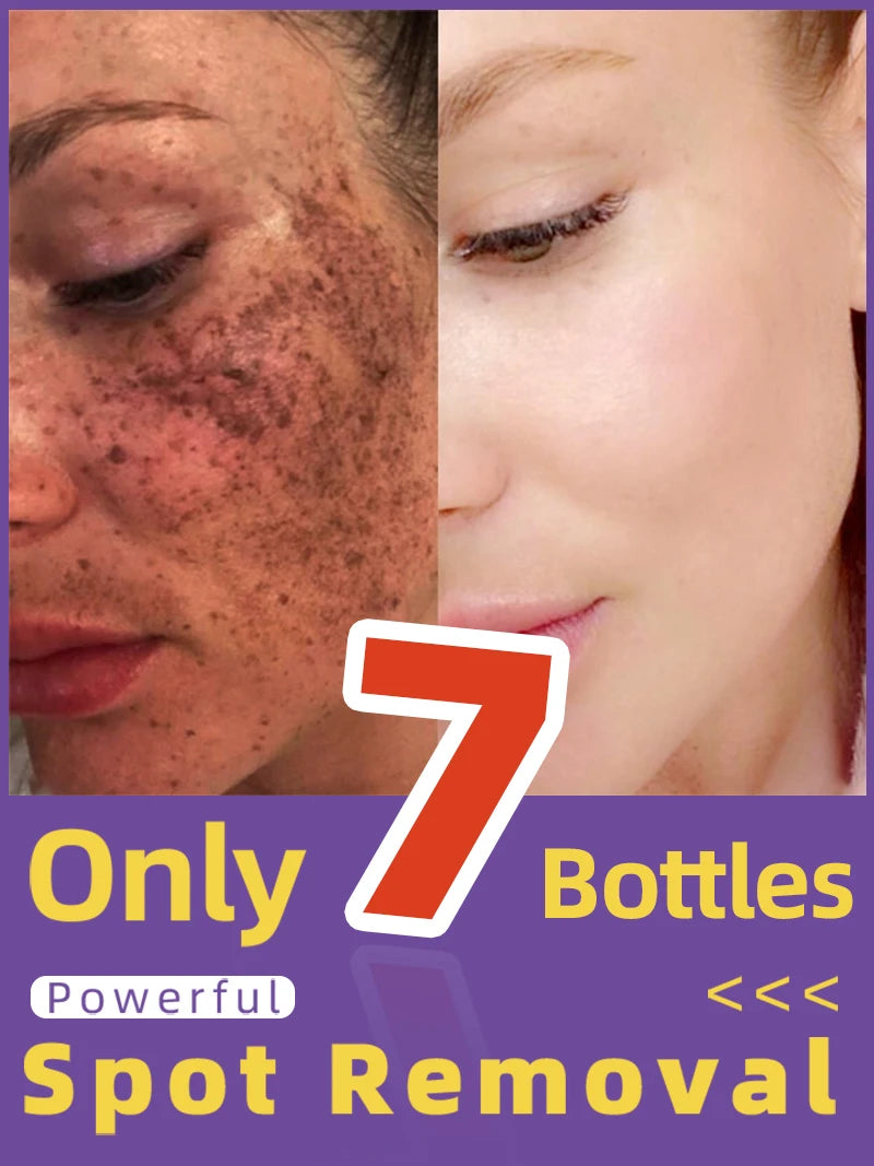 Facial Lightening for Freckles, Melasma & Dark Spots