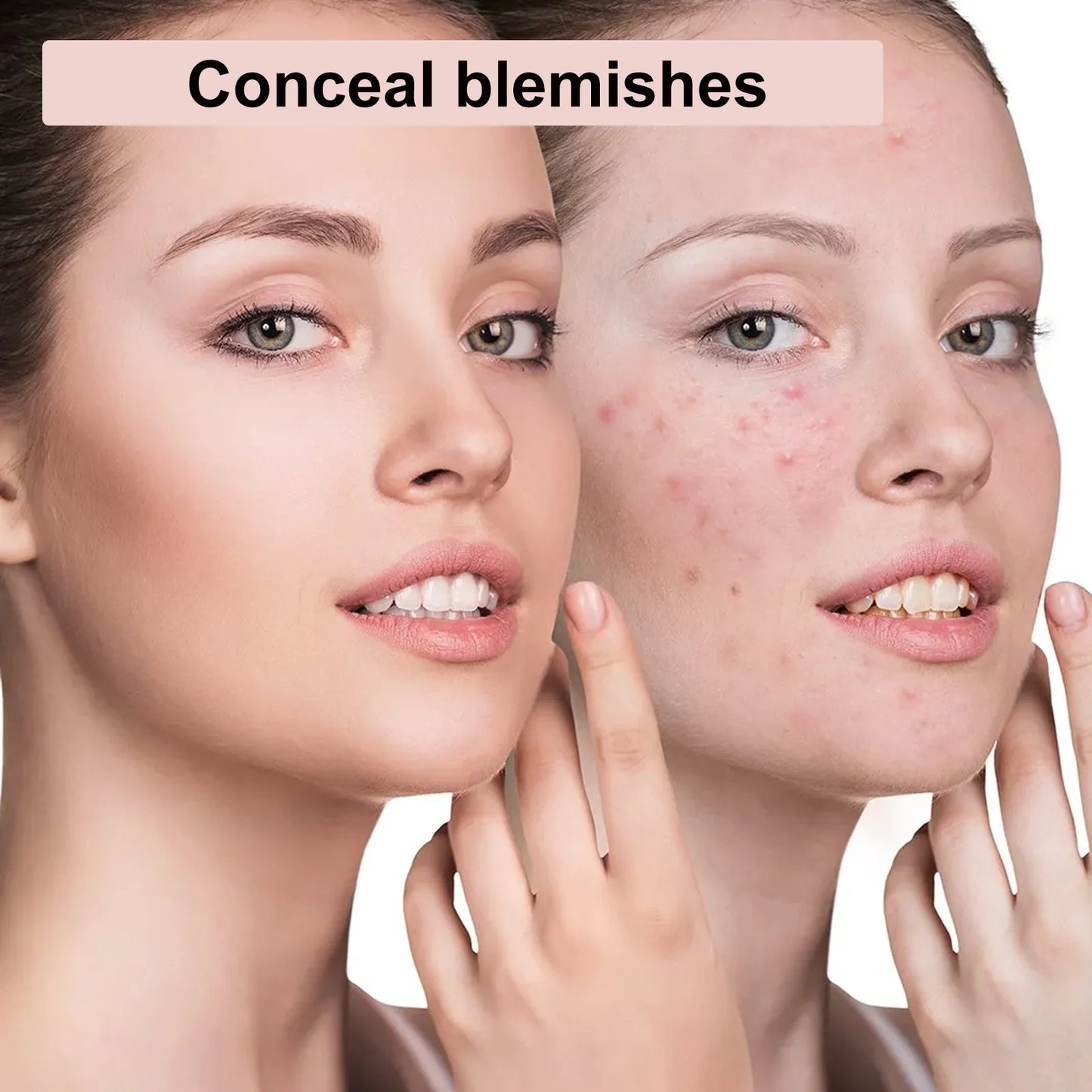 Acne Patches 88 Pcs, Invisible Hydrocolloid Pimple Patches for Face, Overnight Absorb Pus, Gentle on Sensitive Skin