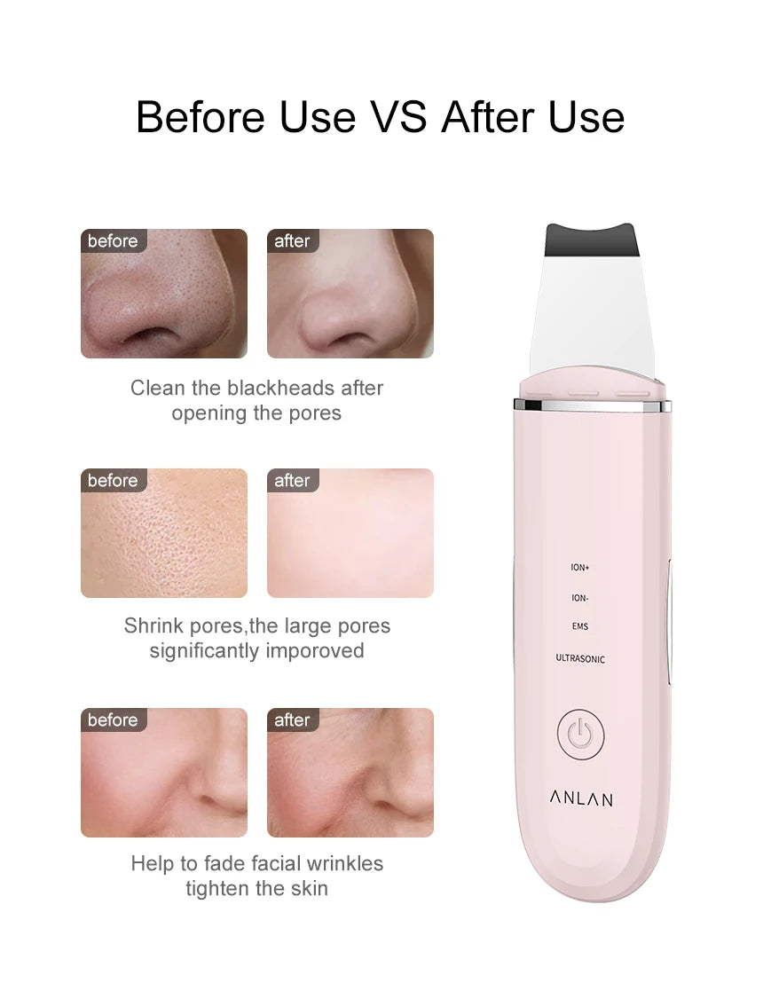 ANLAN Ultrasonic Skin Scrubber Facial Pore Cleansing Spatula Microcurrent Facial Lifting Ultrasonic Peeling Beauty Skincare Tool