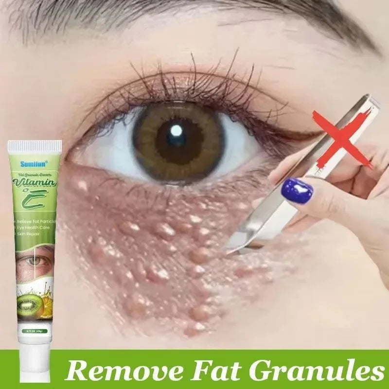 Fat Granules Remover Eye Cream Effective Remove Fat Granules Puffiness Anti-Particles Milia Remover Product Repair Eye Skin Care