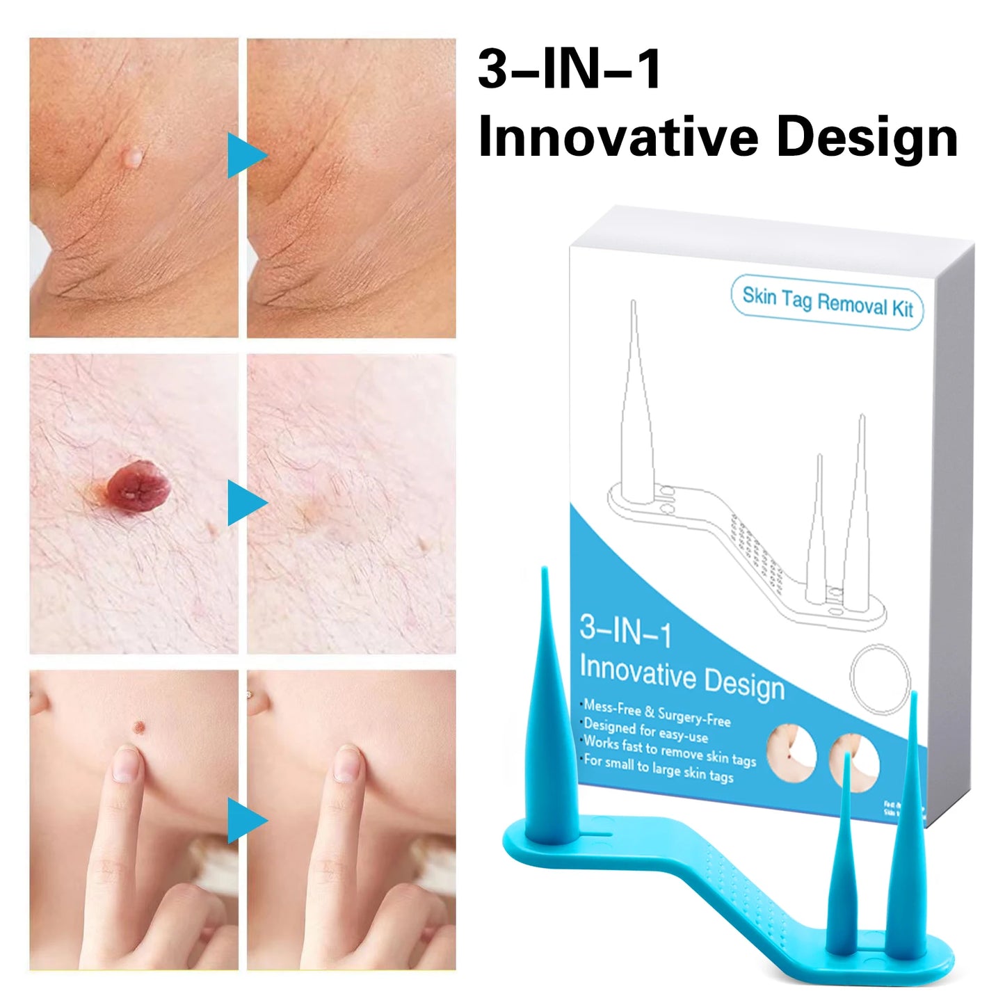 2 IN 1 Auto Micro Skin Tag Remover Device Standard And Micro Skin Tag Removal Kit Adult Mole Wart Remover Face Care Beauty Tools