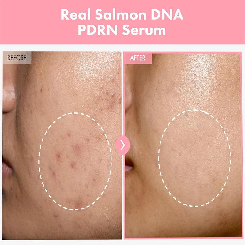 Korean Skincare Complex Peptide Acne Serum with PDRN Collagen - Pore Shrinking Melanin Fading Skin Brightening And Smoothing