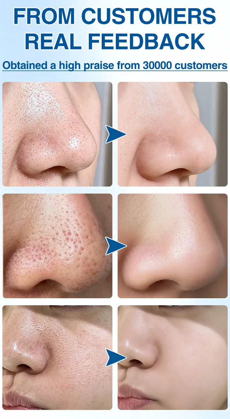 Blackhead Remover Pore Cleaner Black Dots Vacuum Cleaner Skin Pimple Acne Extractor Facial Cleaning Electric Black Head Removal.