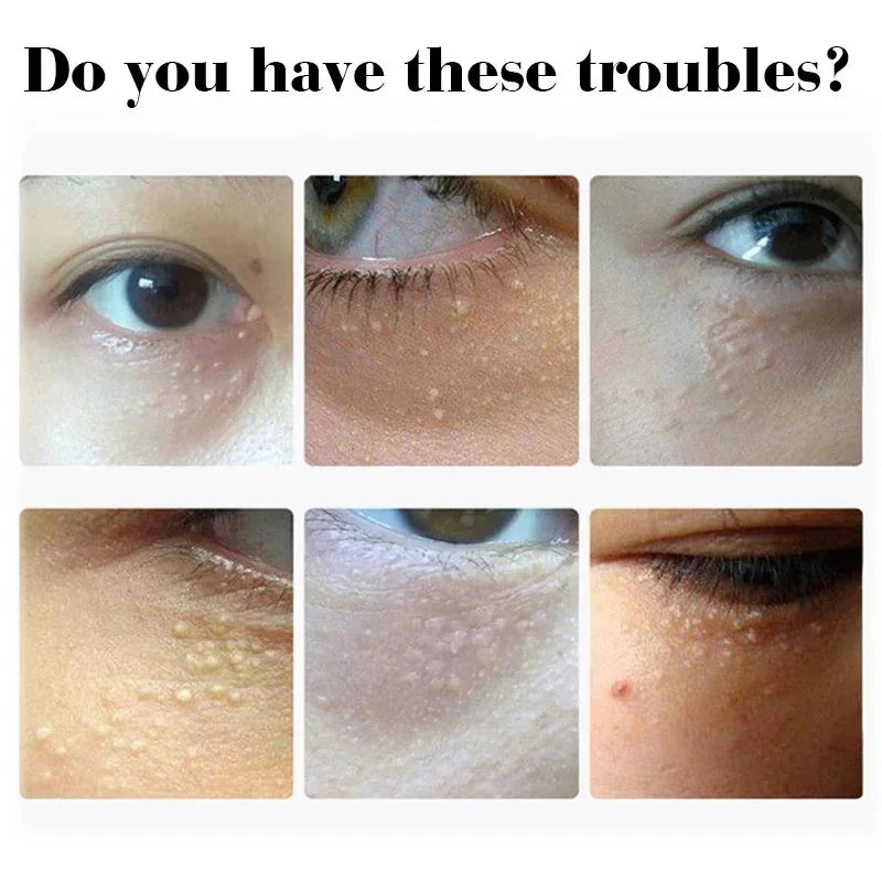 Fat Granules Remover Eye Cream Anti-Puffiness Anti Inflammatory Reduce Dark Circles Eyebags Fade Lines Moisturizing Eye Care