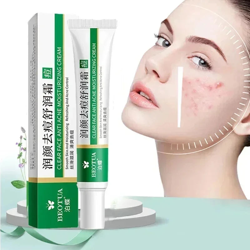 Herbal Acne & Blackhead Cream – Oil-Control, Pore-Refining Gel for Blemish-Prone Skin