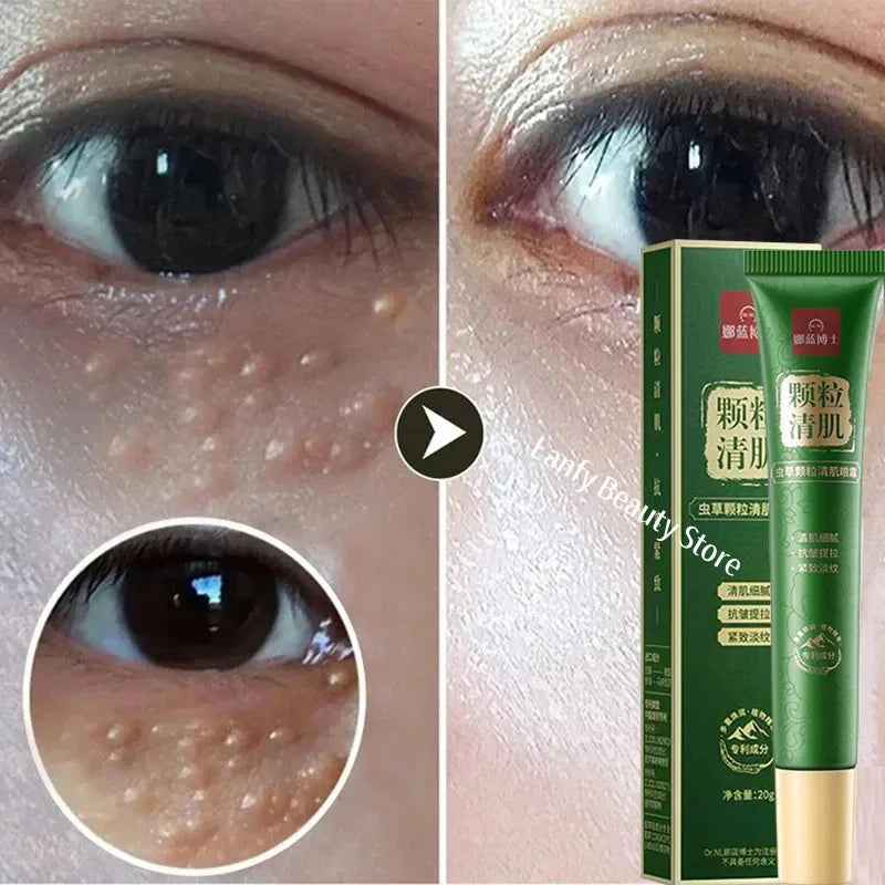 Fat Granules Remover Eye Cream Anti-Puffiness Anti Inflammatory Reduce Dark Circles Eyebags Fade Lines Moisturizing Eye Care