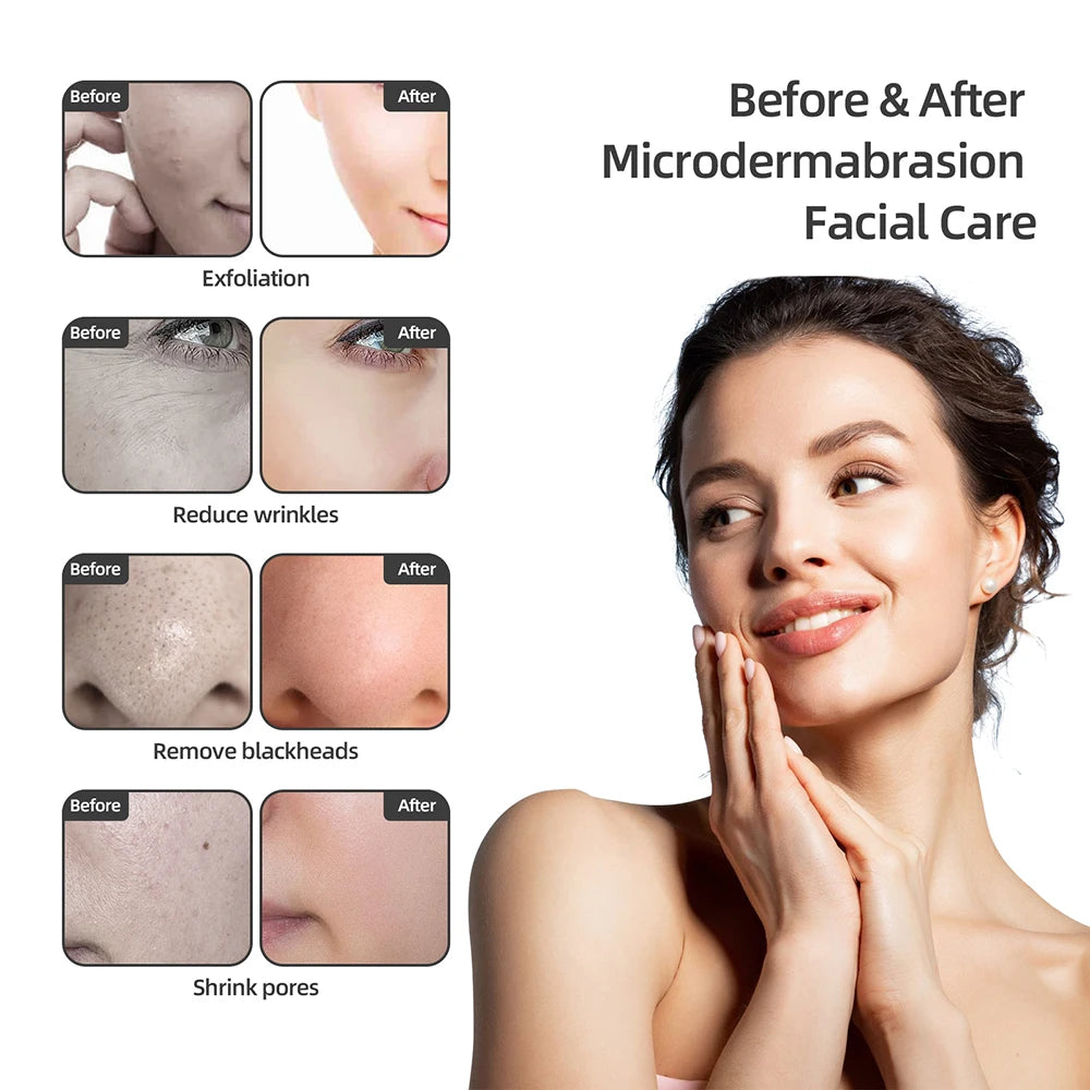 Diamond Microdermabrasion Facial Deep Cleansing Machine