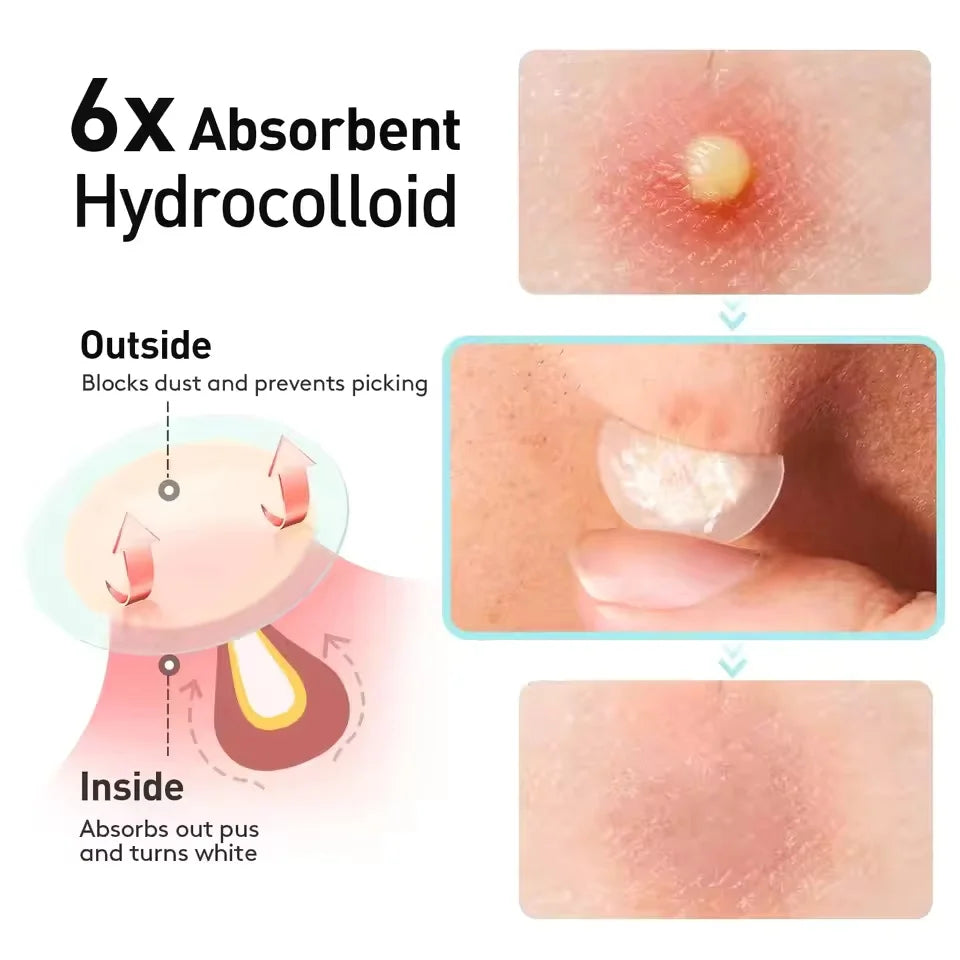 443pcs water-based gel acne patch - removes facial acne, soothes and heals the skin, multiple sizes of oversized acne patches