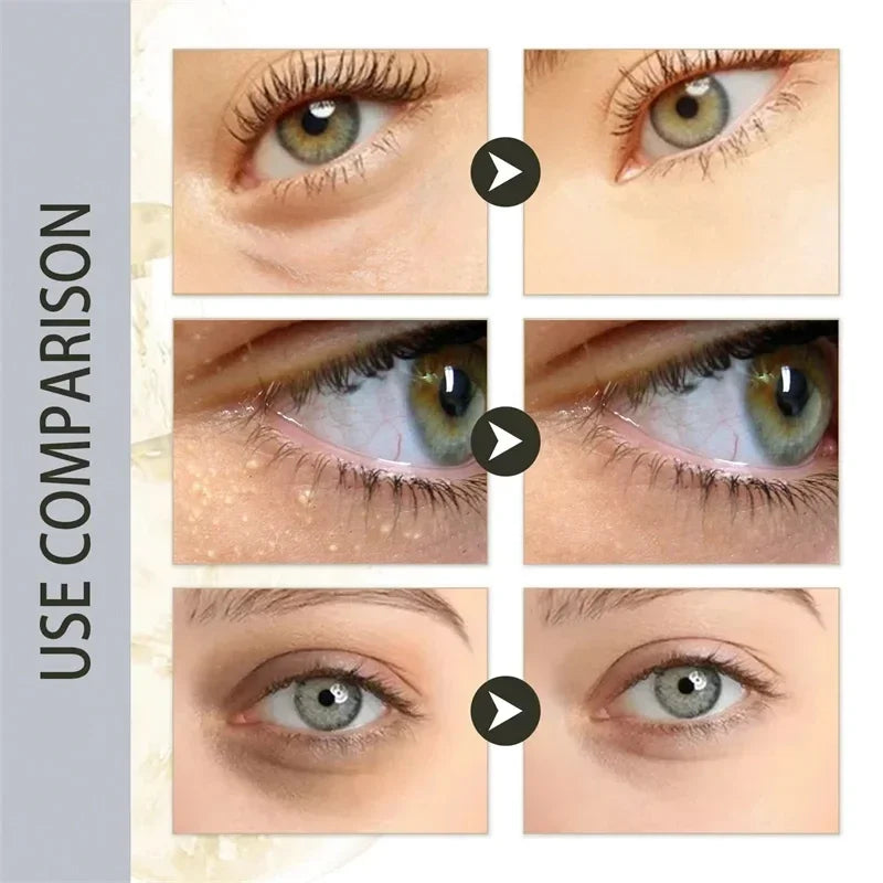 Fat Granules Remover Eye Cream Anti-Puffiness Anti Inflammatory Reduce Dark Circles Eyebags Fade Lines Moisturizing Eye Care New
