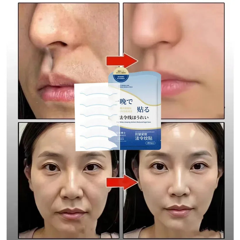 Collagen PDRN Nasolabial Folds Patch Contain Hyaluronic Acid Instant Fade Fine Lines Firming Skin Deep Moisturizing Facial Mask