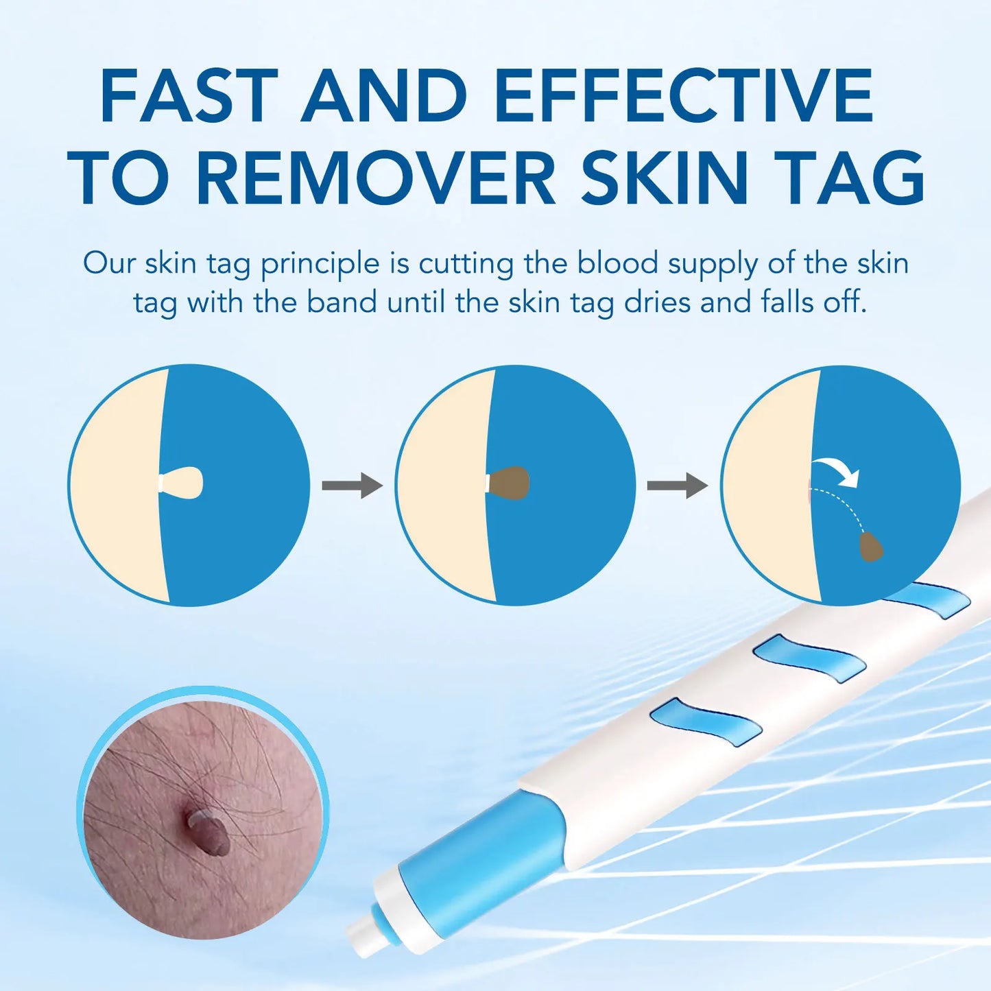 2 IN 1 Auto Micro Skin Tag Remover Device Standard And Micro Skin Tag Removal Kit Adult Mole Wart Remover Face Care Beauty Tools