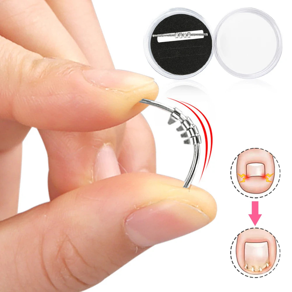 Ingrown Toenail Pedicure Tool Embed Toe Nail Care Straightening Correction Clip Curved Clamp Toenails Correction Tool for Toes