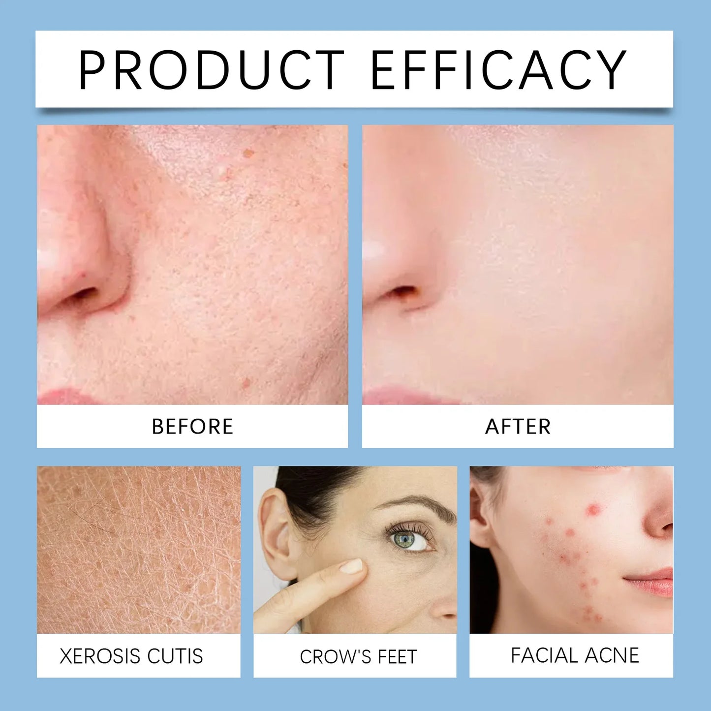 2-in-1 The Pore Eraser" Salicylic Exfoliating Pads-Double Acid Action:AHA+BHA,Clear Pores&Acne&Blackhead Terminato,Full-Body Use