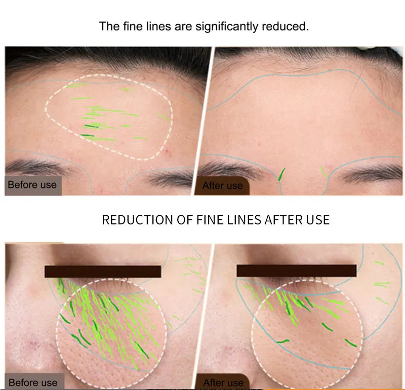 EMS Facial Body Radio Frequency Machine Skin Tightening Face Lifting RF Beauty Device Professional Home RF Skin Care Anti Aging, women