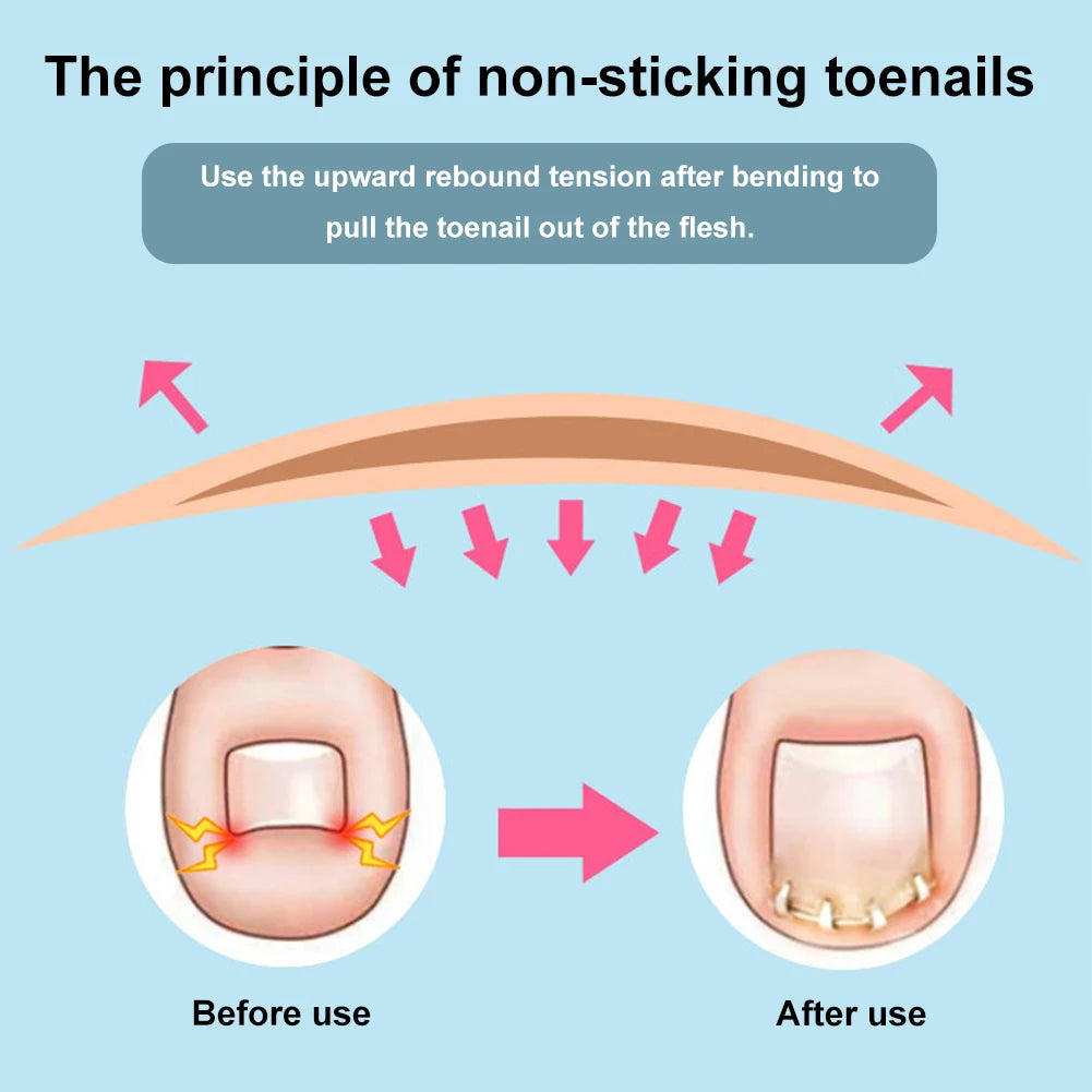 Ingrown Toenail Pedicure Tool Embed Toe Nail Care Straightening Correction Clip Curved Clamp Toenails Correction Tool for Toes