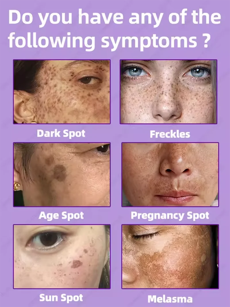 Facial Lightening for Freckles, Melasma & Dark Spots