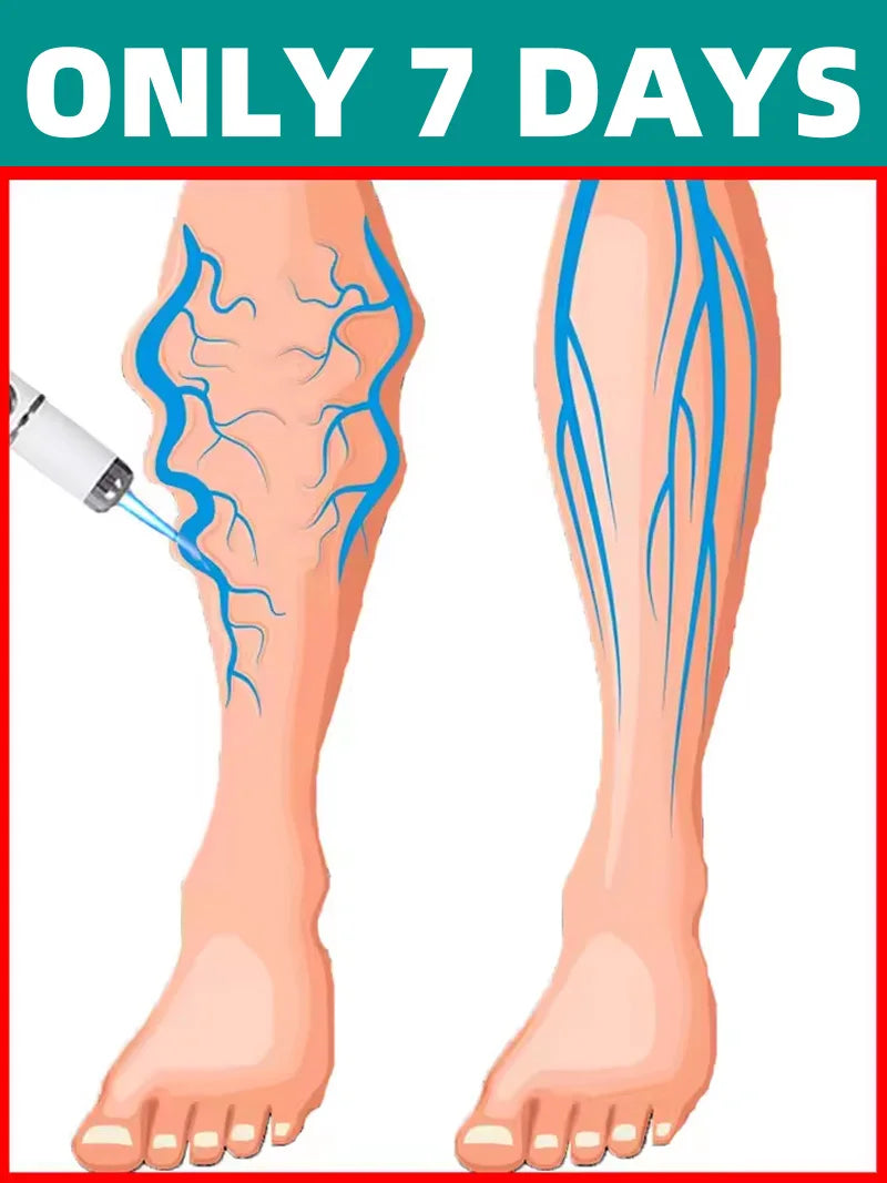 2026 New Blue Light Pen to Solve Venous insufficiency Legs care Tools
