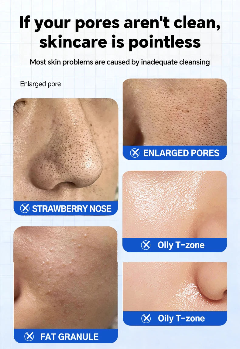 Blackhead Remover Pore Cleaner Black Dots Vacuum Cleaner Skin Pimple Acne Extractor Facial Cleaning Electric Black Head Removal.