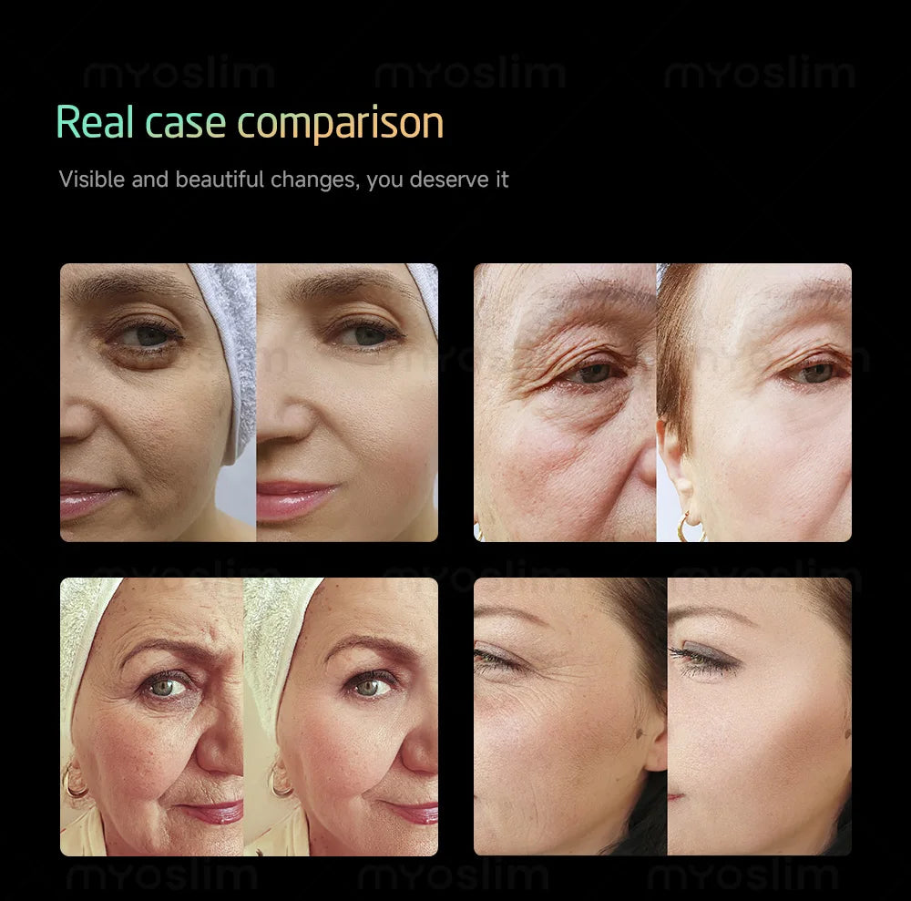 Portable RF Lift Machine — Facial & Body Skin Firming Device