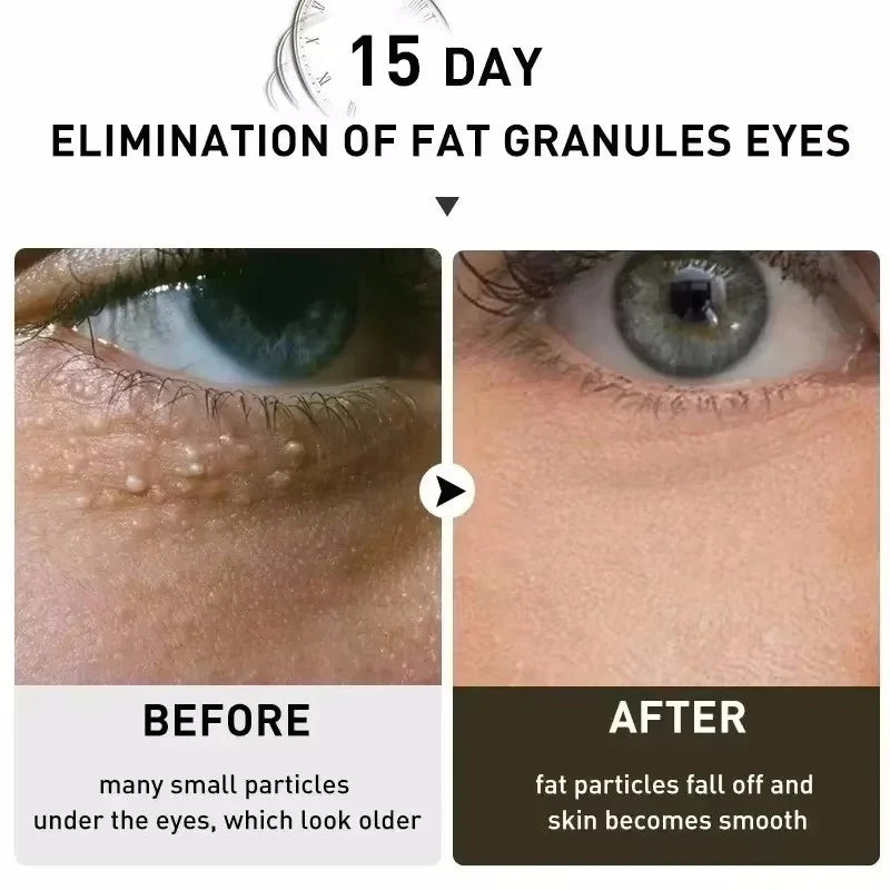 Fat Granules Remover Eye Cream Anti-Puffiness Anti Inflammatory Reduce Dark Circles Eyebags Fade Lines Moisturizing Eye Care